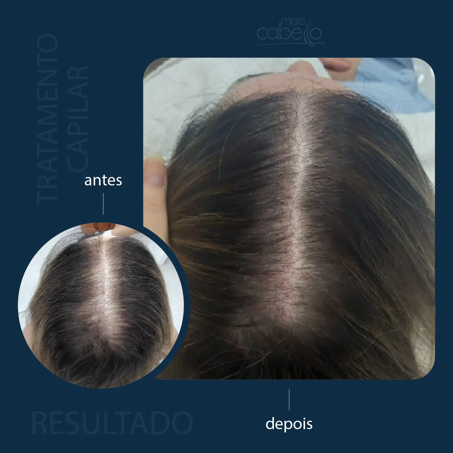 Antes e depois de protocolo na linha capilar